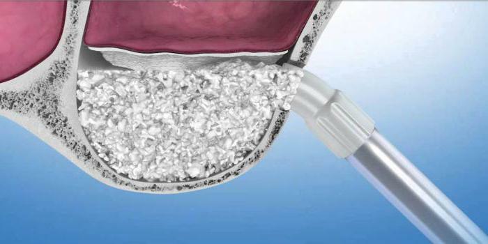 sinus lifting use for implantation of teeth