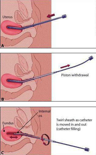 aspiration pinch endometrial biopsy