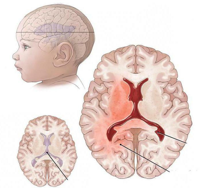 brain of newborn