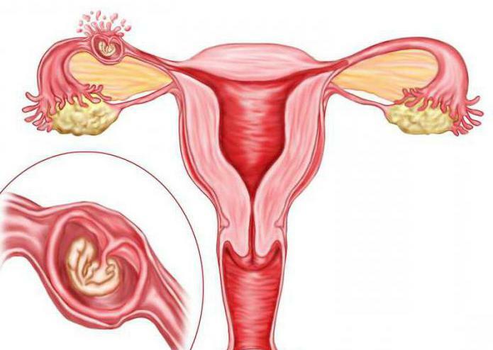 ectopic pregnancy tubal abortion