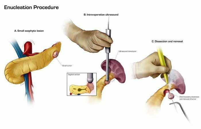 Métodos para diagnosticar pancreatite