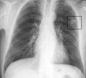 سوف الأشعة السينية تظهر سرطان الرئة