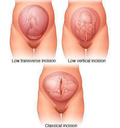 scar on the uterus after caesarean section