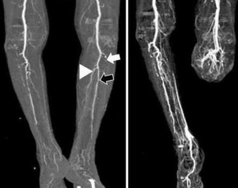 angiography of the vessels of the lower extremities what is it?