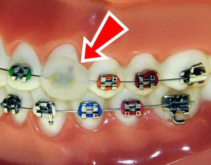 wax for braces how to use