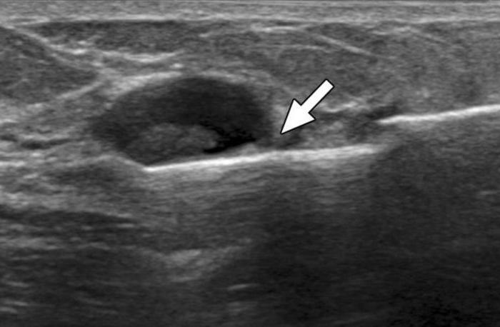 Ultrasound of the mammary glands cysts