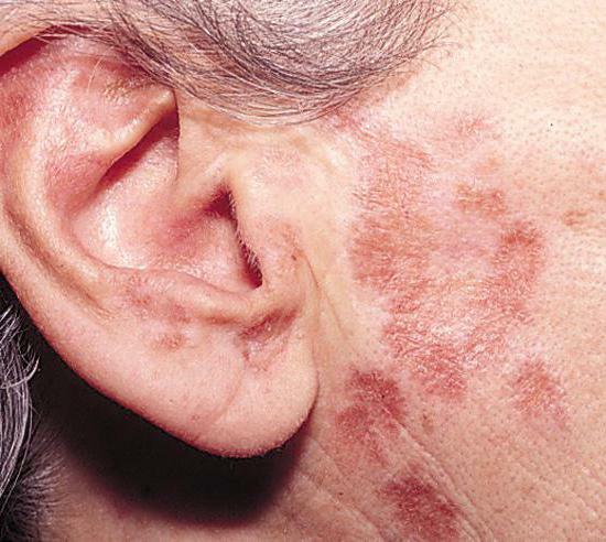 sarcoidosis skin diagnosis