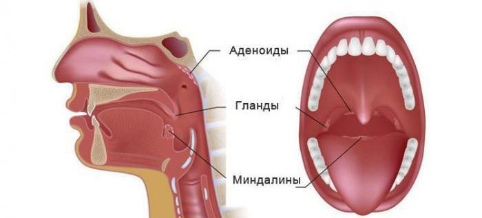 adenoidná hypertrofia