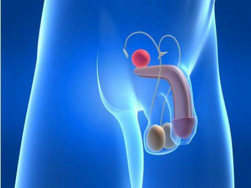 prostate cancer 2 degree treatment reviews