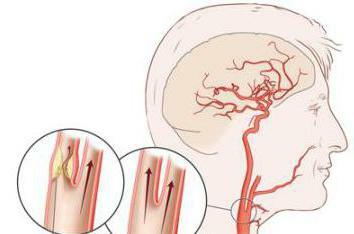 semne de angioedem al vaselor cerebrale