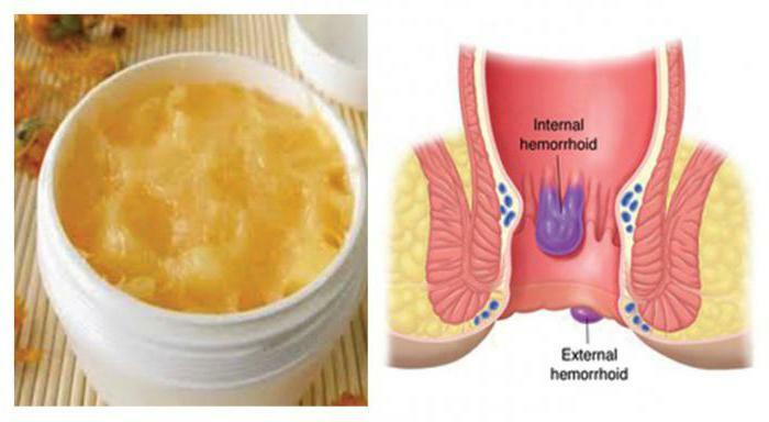 Hemorrhoids during pregnancy treatment of ointments