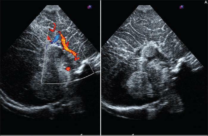 brain echoencephalography in children