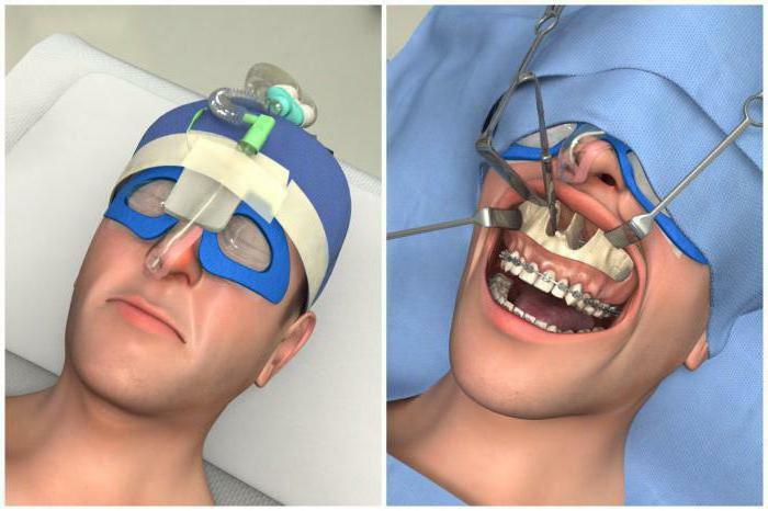 orthognathic surgery on the upper jaw