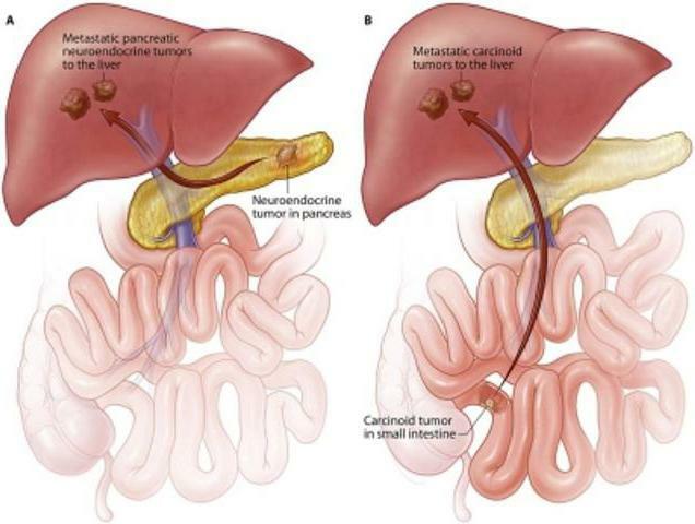 karcinoidni sindrom i karcinoidni tumor