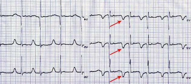 EKG