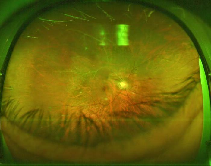 retinal arterie okklusion