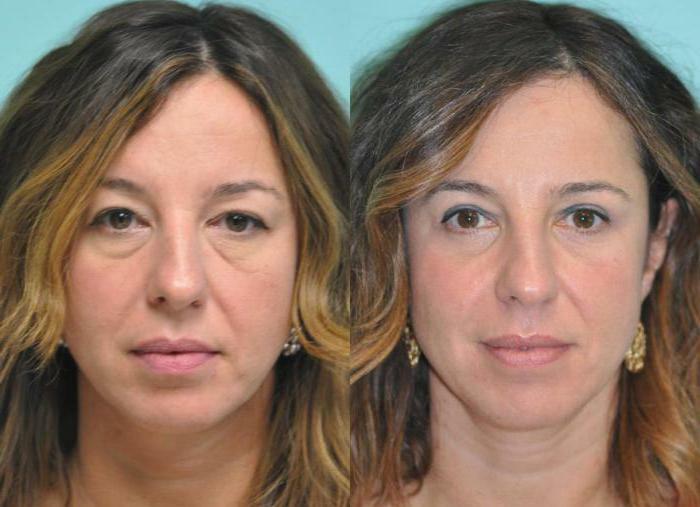 blepharoplasty of lower eyelids in Moscow