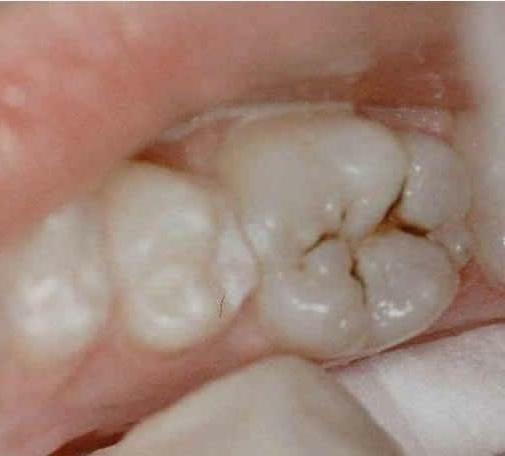 dental caries treatment