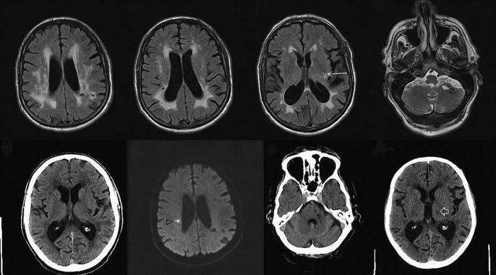 causes of Parkinson