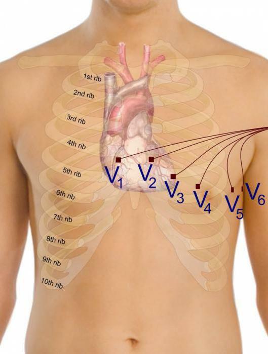 how to remove the ECG electrode overlay scheme