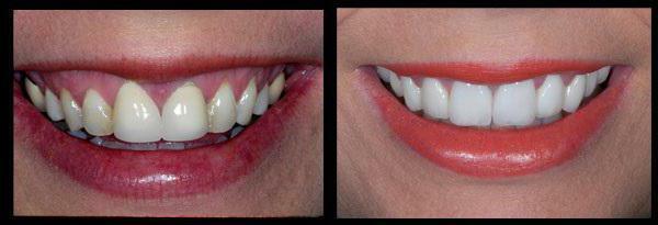 Ceramic crowns on the front teeth