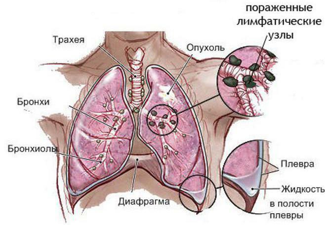 v poslednej fáze rakoviny pľúc koľko ľudí žije