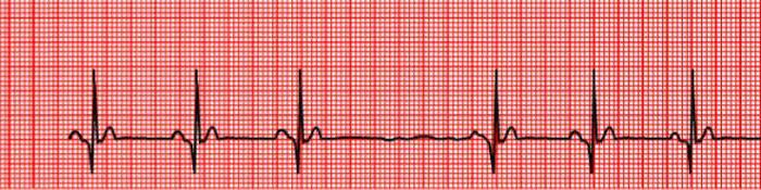 sinoatrial compus