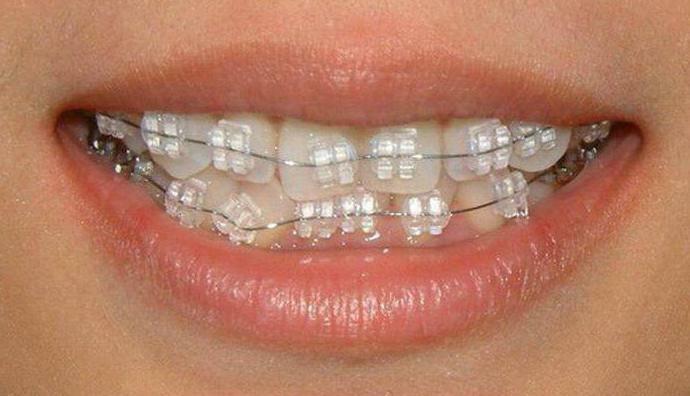 braces what are the price