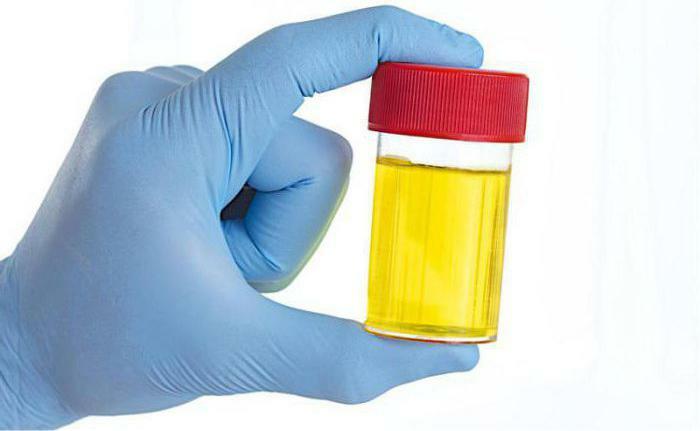 Leukocyte Esterase In The Urine What Is It Leukocyte Esterase In Urinalysis Transcript 7130