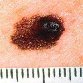 melanoma skin projections of life photo