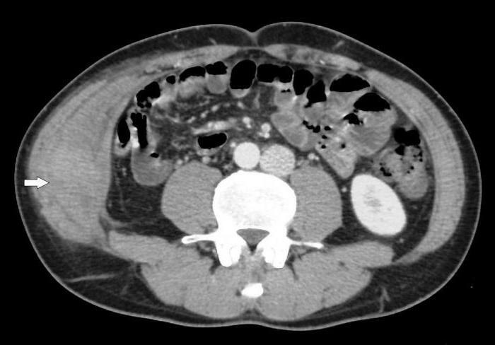 aberrant pancreas in the stomach