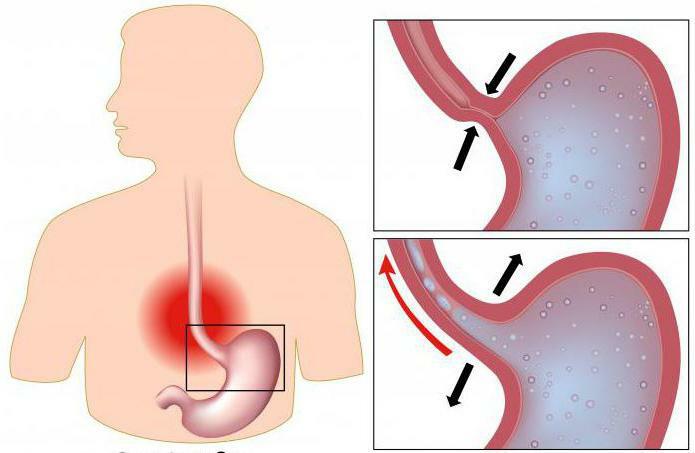stenosis of the esophagus
