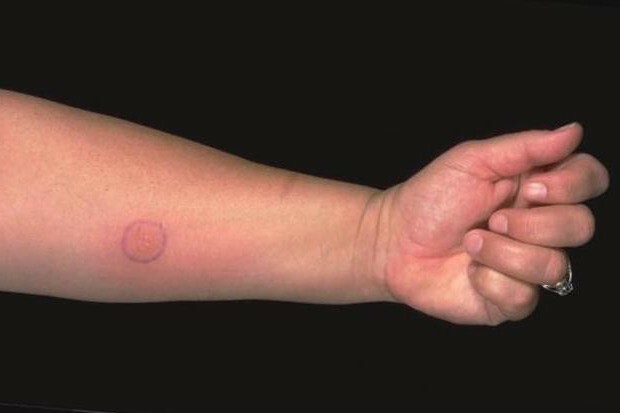 the circulation of tuberculin test in children is transmitted