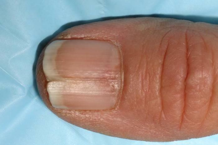 Melanoma of the nail initial stage