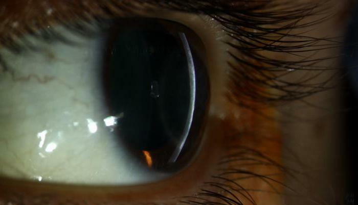 Herpetic keratitis of the eye