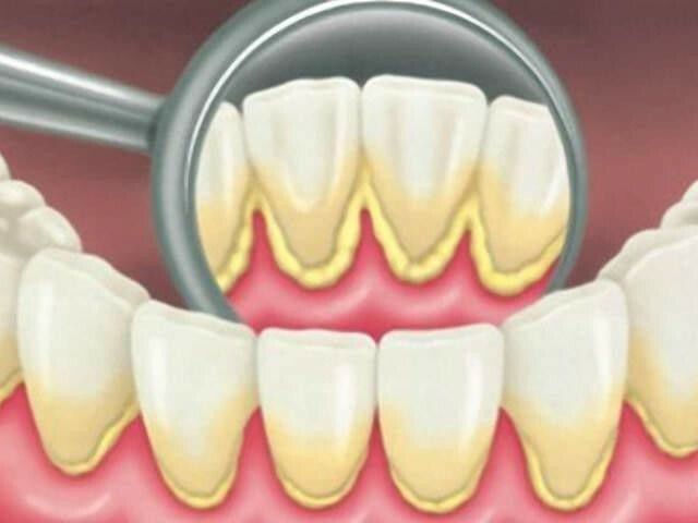 dental deposits