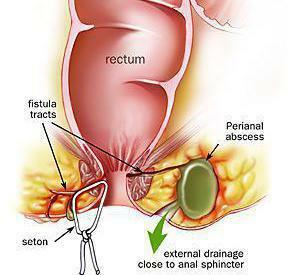 treatment of the fistula of the rectum without surgery by folk remedies