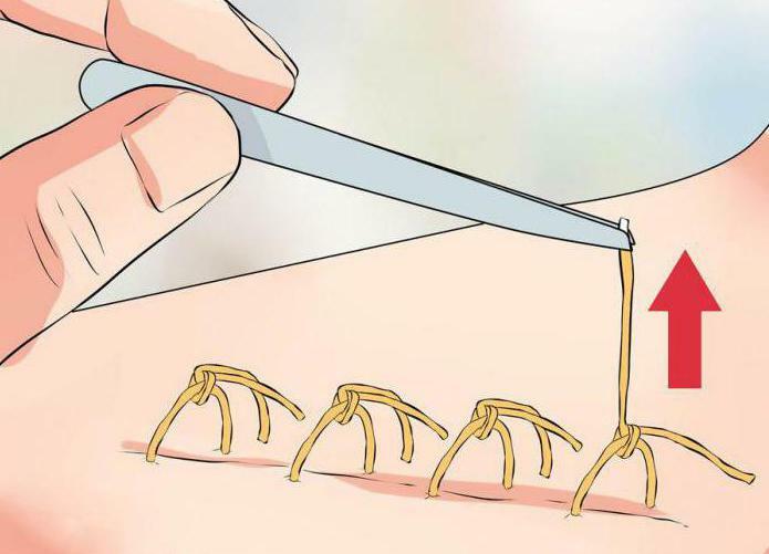 how to remove stitches at home
