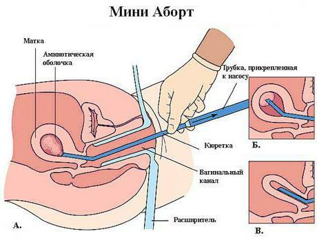 vacuum termination of pregnancy