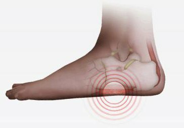 bolesť v nohe medzi pätou a liečbou špičky