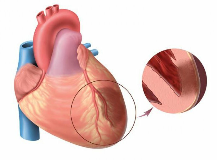 acute transmural infarction