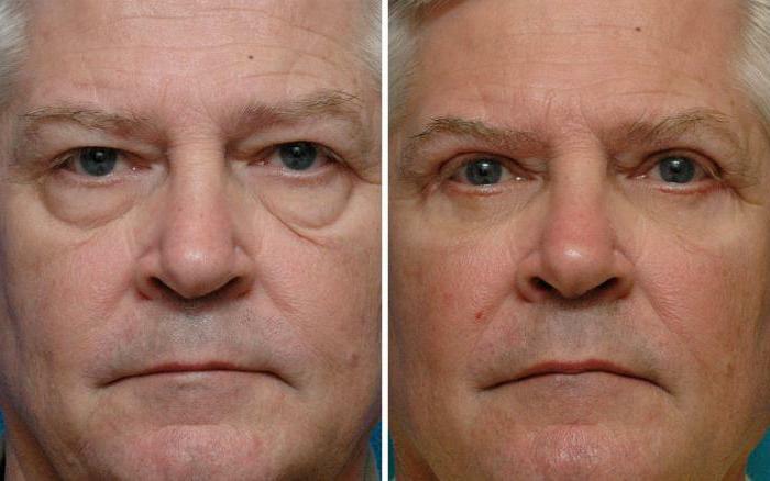 best blepharoplasty in moscow