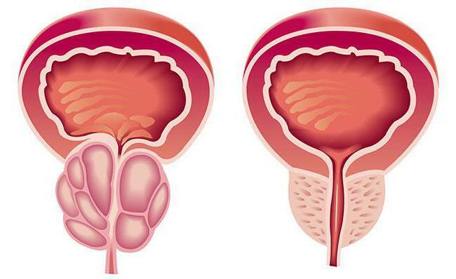 zariadenia na liečbu prostatitídy v domácnosti