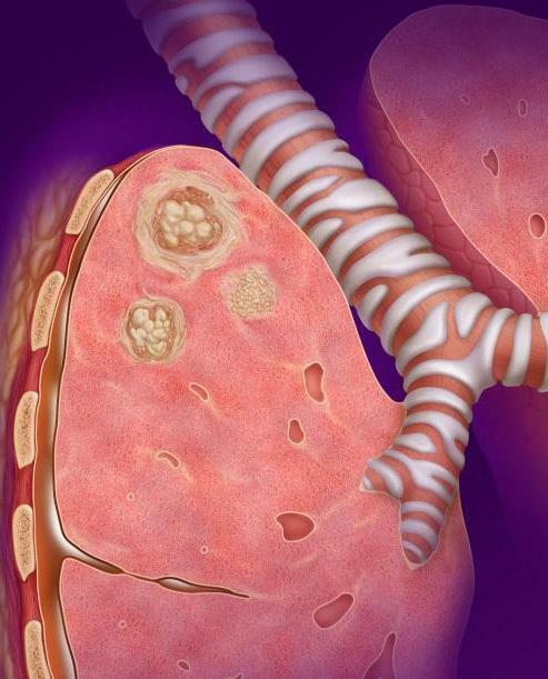 caseous pneumonia