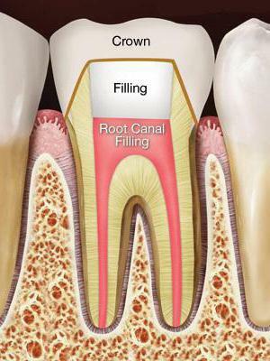 treatment for root canal filling
