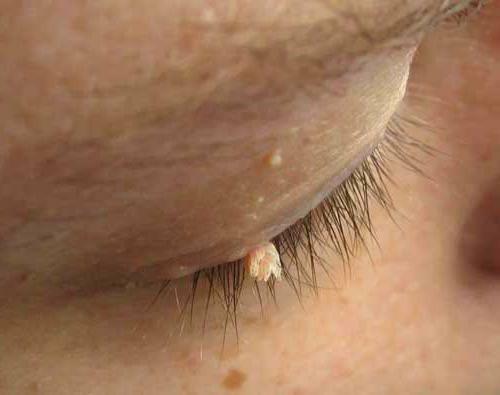 cryodestruction of the papilloma on the eyelid