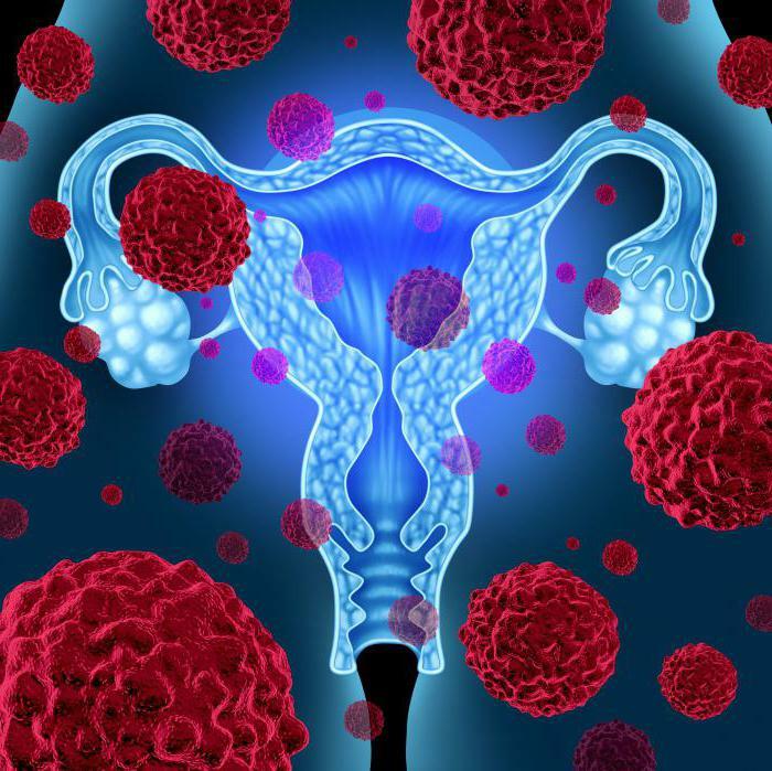 sarcoma of the uterus