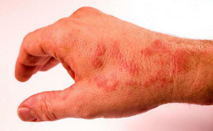 redness and itching on the arms in the area of ​​the fold