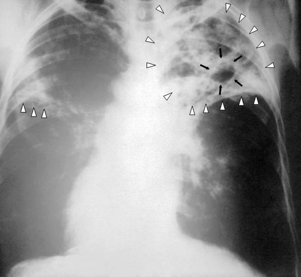Is pulmonary tuberculosis treated?