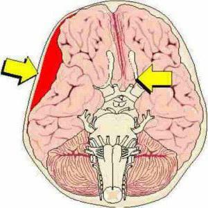 diagnosis of cerebral compression